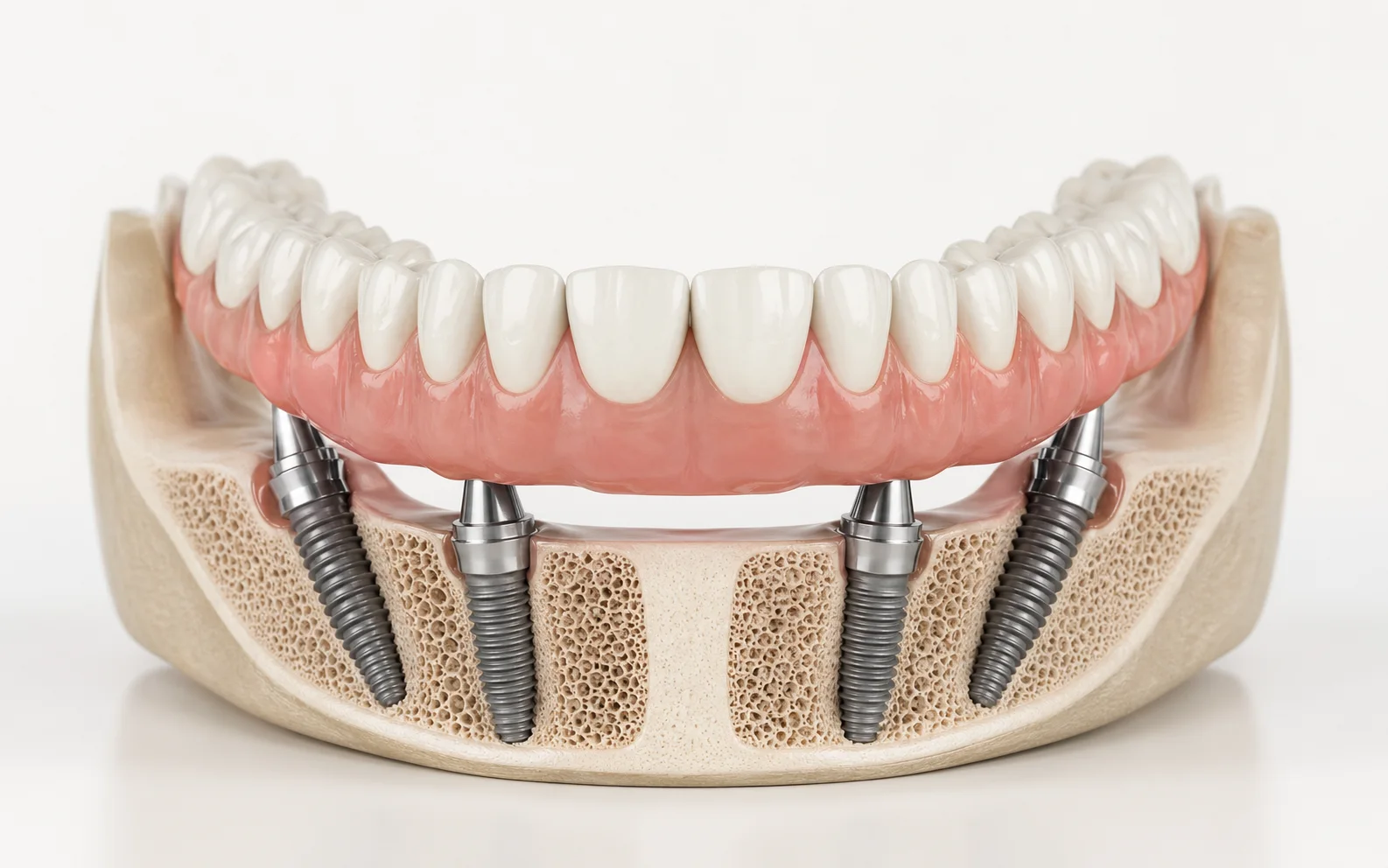 Full arch bridge supported by dental implants