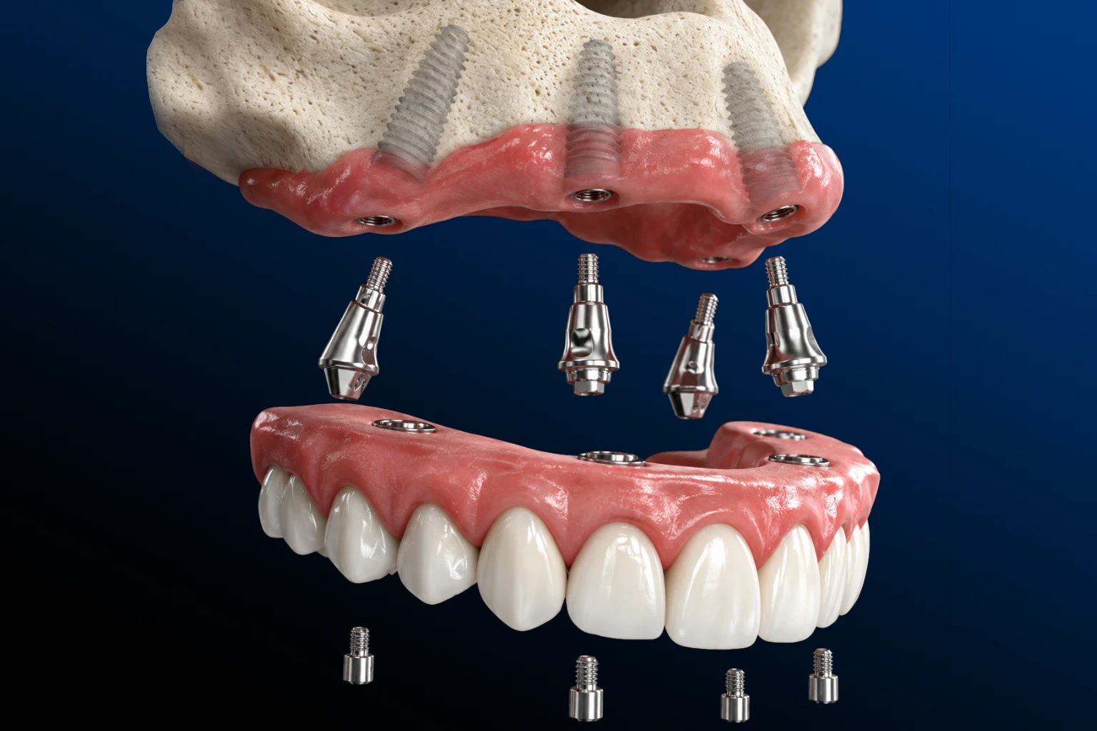 Dental Implants