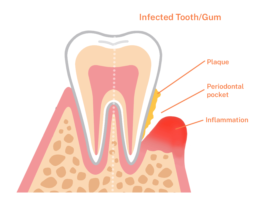 periodontitis