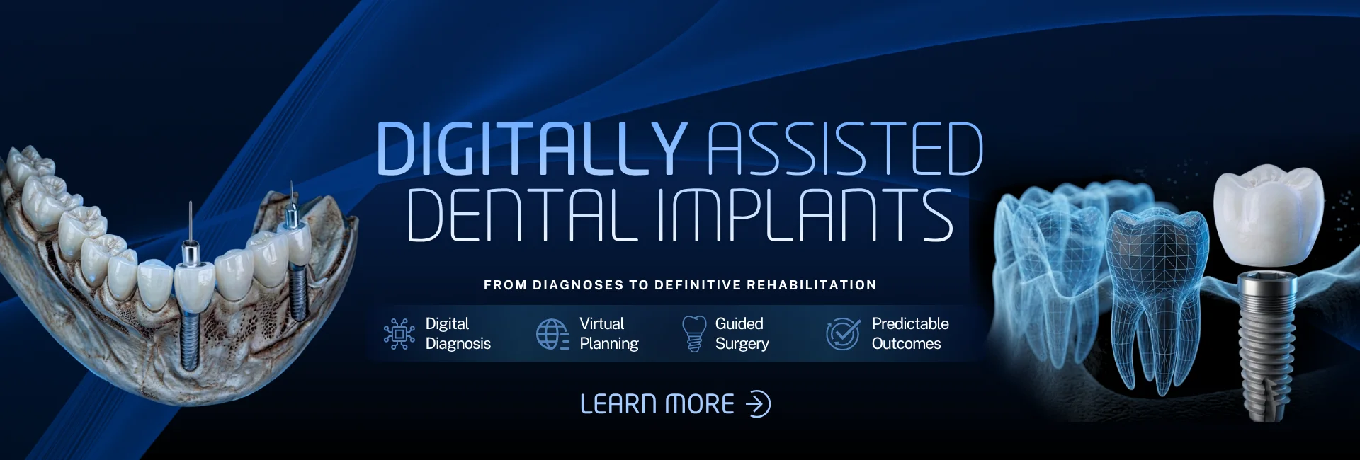 dental-implants