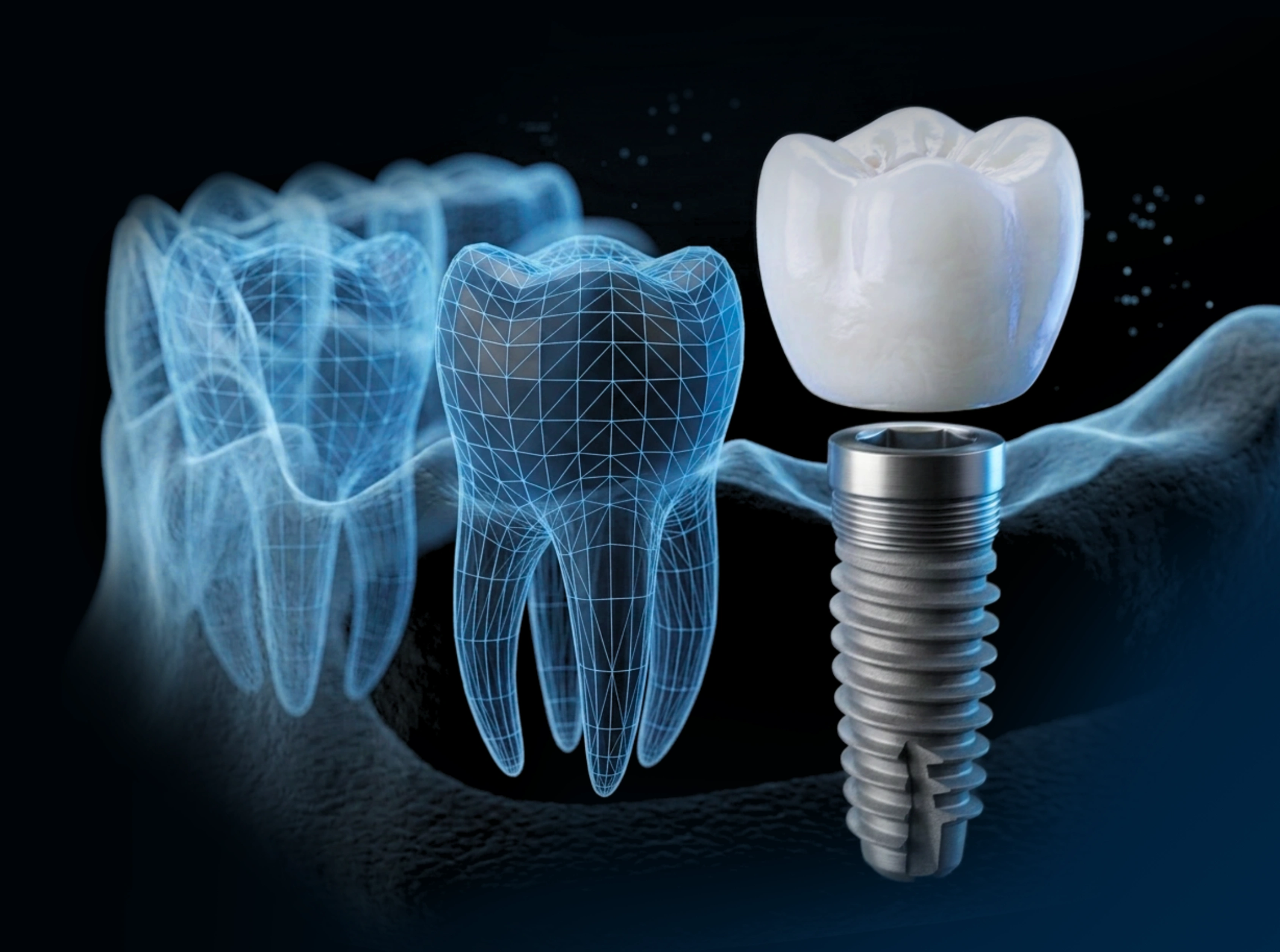 Full mouth implant patient smiling