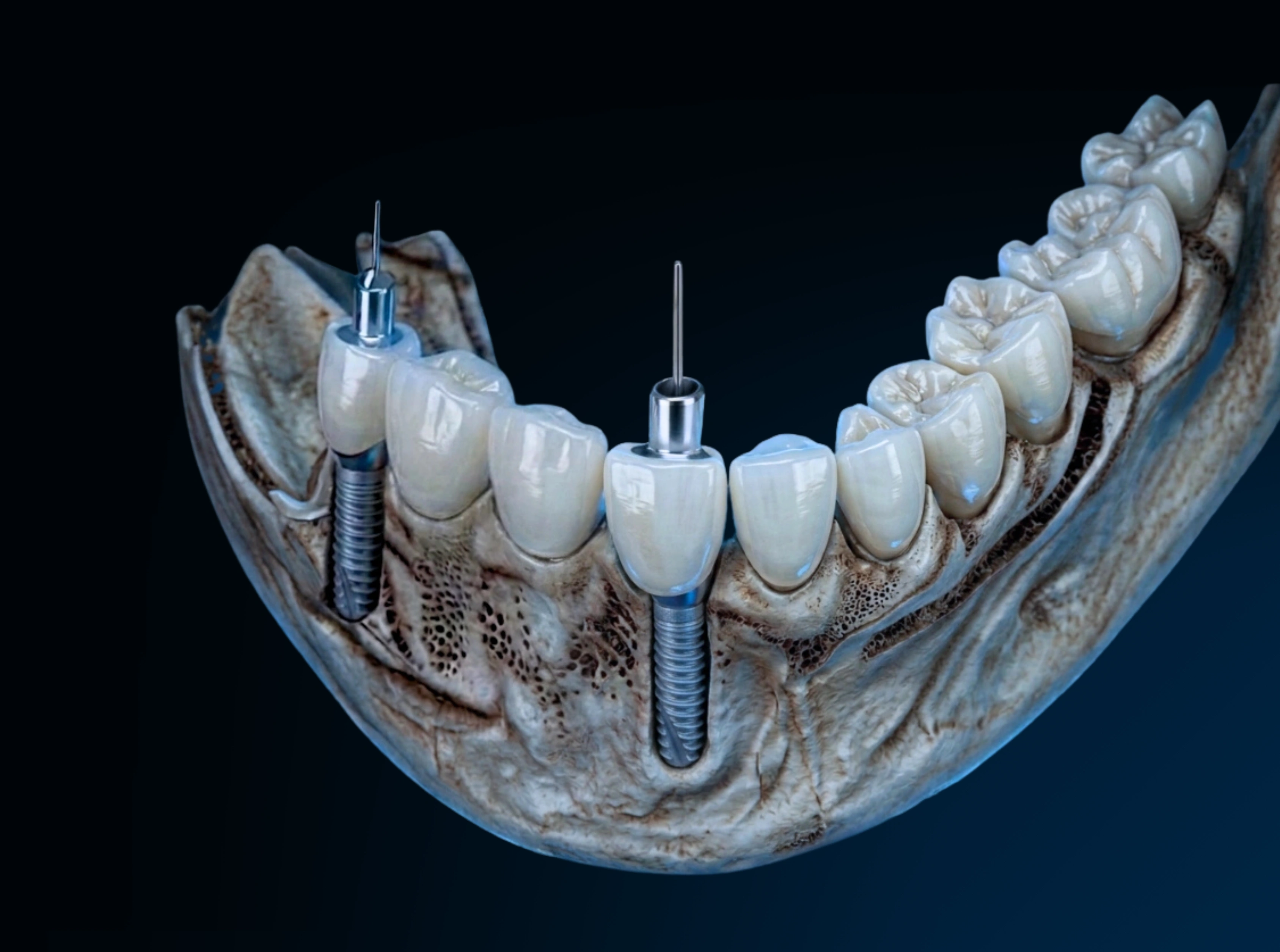 Digital implant planning on screen