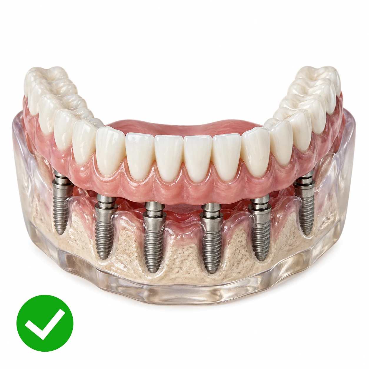Fixed implant bridge