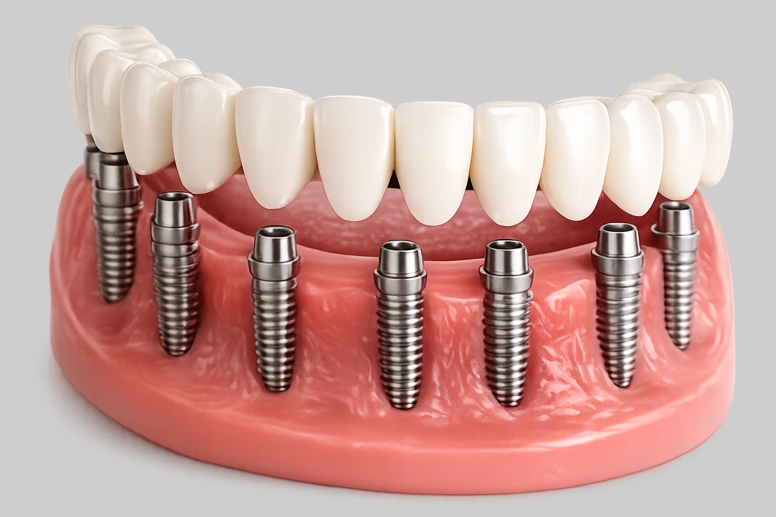 Dental implants model