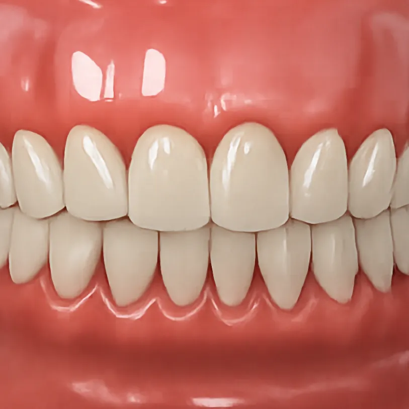 Temporary teeth for implant treatment